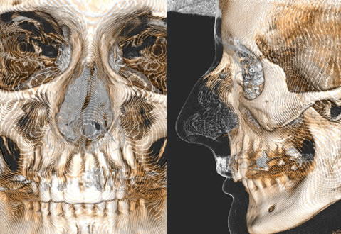 Il rendering 3D e di ovvia utilità nello studio preoperatorio delle ossa nasali componente ossea del setto
