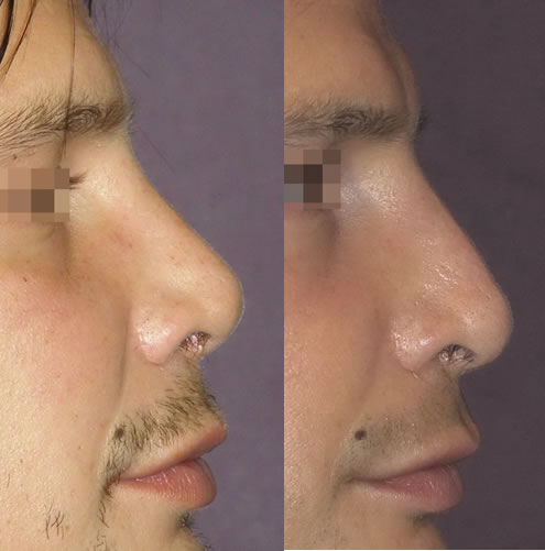 Ricostruzione secondaria composita del dorso il naso corto e femminilizzato 
