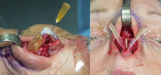Esempi di utilizzo di segmenti cartilagine costale per ricostruire le cartilagini triangolari (a sx) e le alari (a dx). 