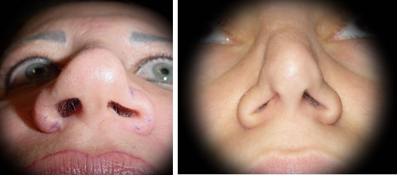 In questi casi è evidente la destrutturazione delle cartilagini alari avvenuta per eccesso di resezione: ne consegue debolezza e deformità della parete laterale, con collasso dell’ala nasale in inspirazione