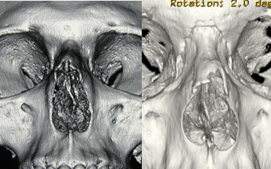 In queste TAC con rendering 3D si nota l’asimmetria delle ossa nasali e la deviazione del setto