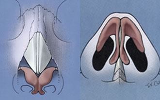 Le ossa nasali e le cartilagini triangolari, che definiscono gran parte del dorso, ed alari, che costituiscono le due arcate cartilaginee della punta ed i due “duomi”