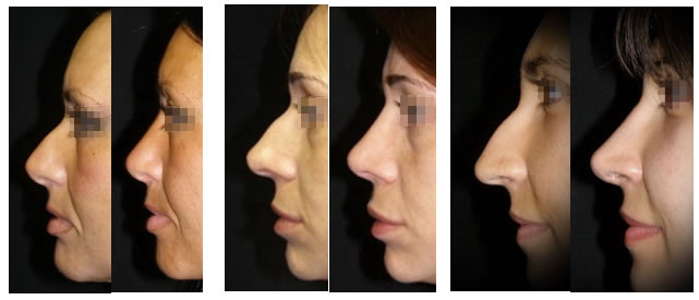 Esempi di casi in cui un innesto di riempimento alla radice migliora le proporzioni del naso