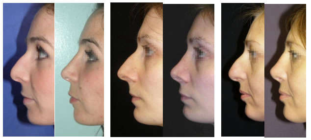Esempi di casi in cui si sono usati innesti sia alla radice che alla punta per migliorare la proporzioni del naso.