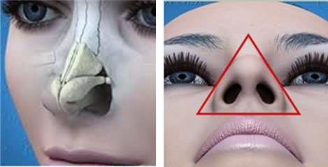 Forma, dimensione e spessore delle cartilagini “alari” determinano l’aspetto della punta. La rinoplastica “aperta” consente al meglio, in modo “strutturale” e sotto visione diretta, di modificare questi parametri 