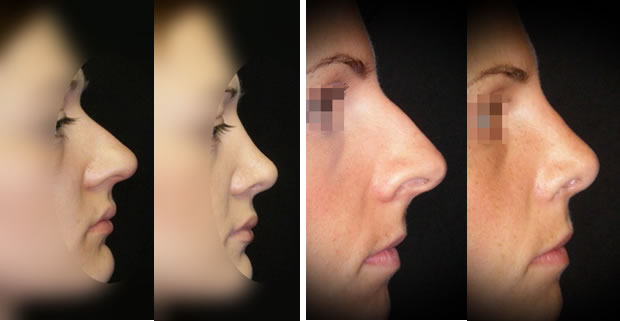 L'iperproiezione spesso si accompagna ad un naso “in tensione”, che pone quasi in trazione il labbro superiore. Per normalizzare l'angolo tra columella e labbro, e’ allora necessario modificare la spina nasale e/o la porzione bassa del setto